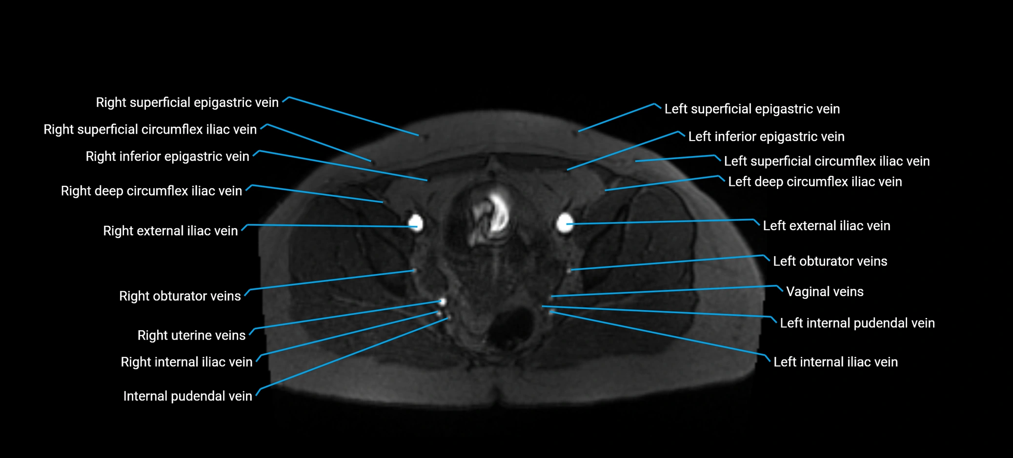 MRV abdomen pelvis & lower limb axial cross sectional anatomy labelled MRI image 164 (1).webp